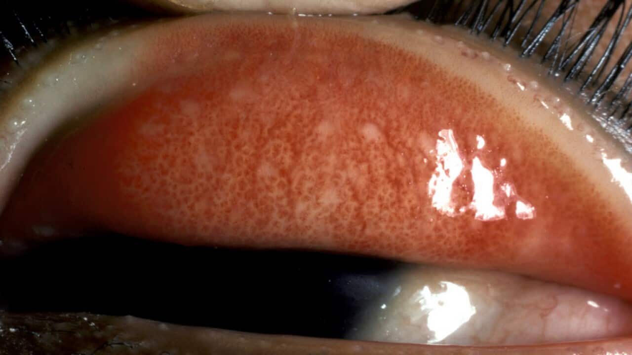 Patient suffering from Trachoma