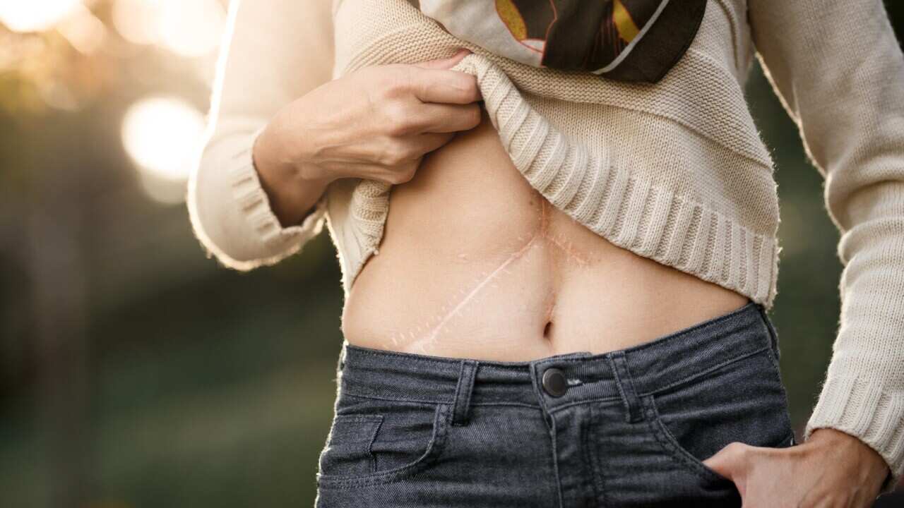 organ donation, liver transplant scar