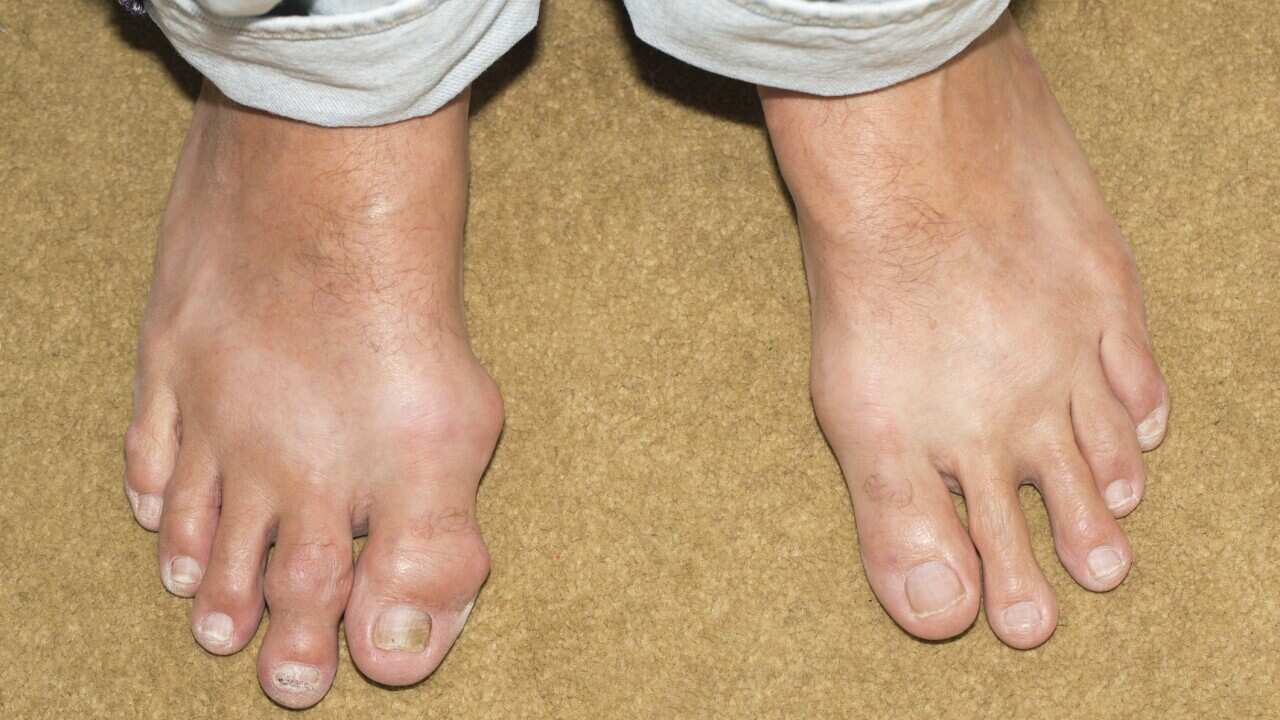 Male foot with gout, Germany