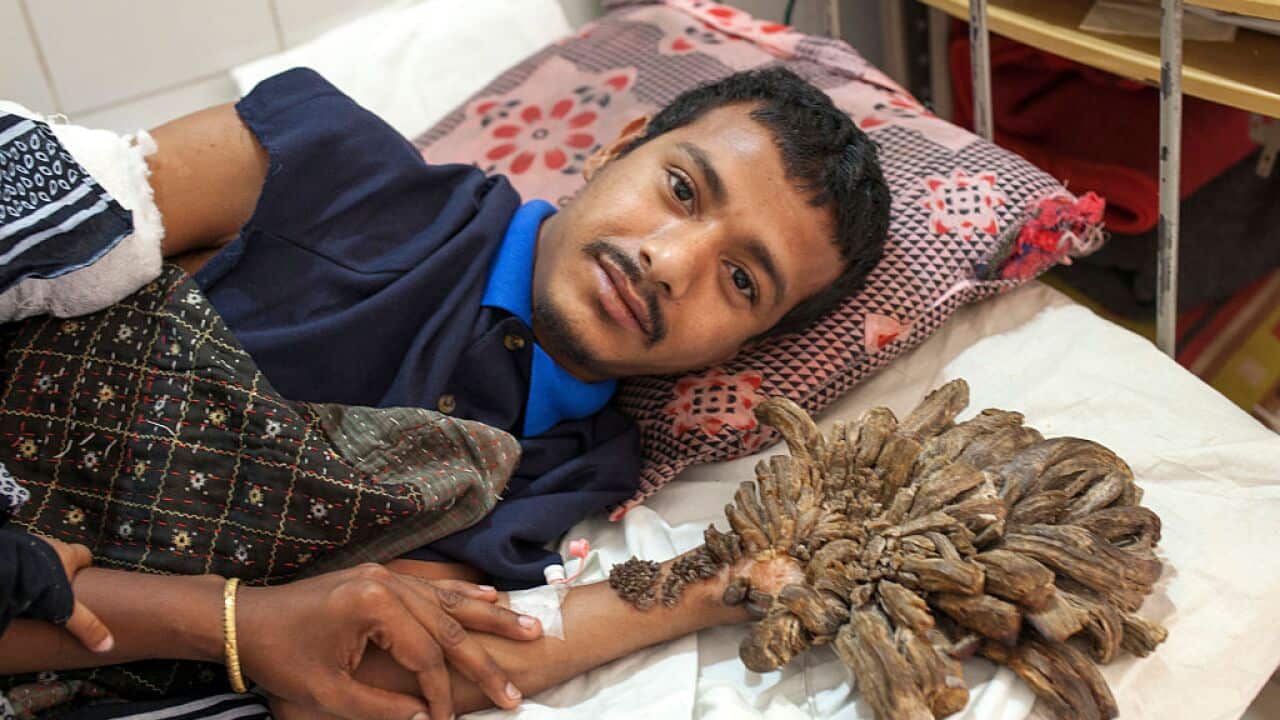 "Tree man" Abul Bajandar from Bangladesh undergoes surgery