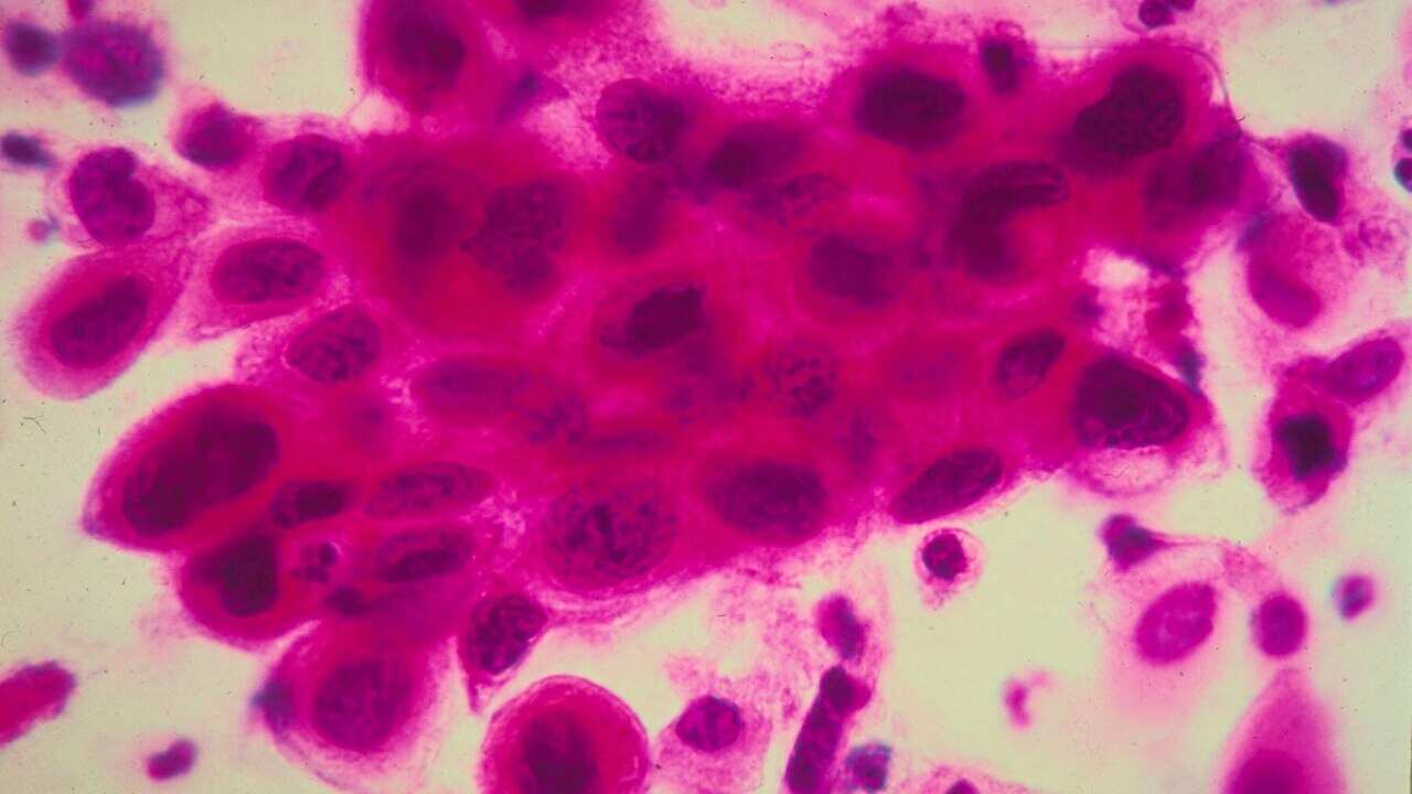 Close up of cancer cells in the cervix