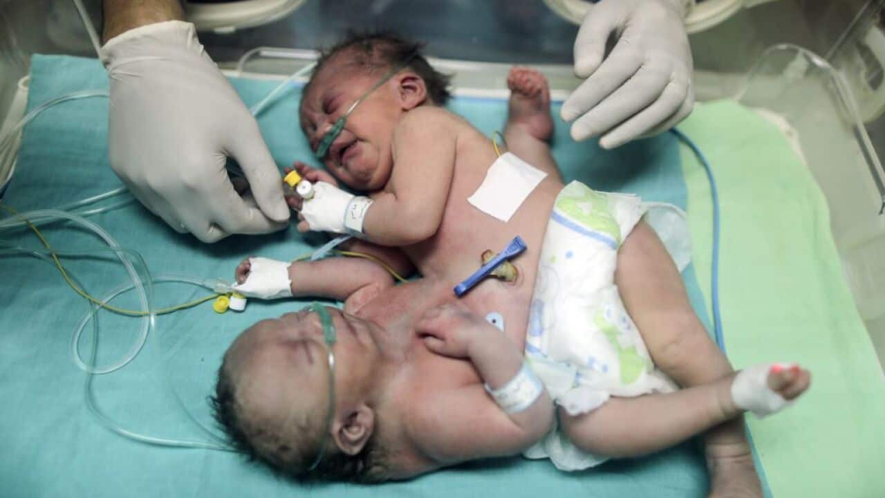 One-day-old Palestinian conjoined twins lie in an incubator at the nursery on October 22, 2017 at al-Shifa Hospital in Gaza City. / AFP PHOTO / MAHMUD HAMS (Photo credit should read MAHMUD HAMS/AFP/Getty Images)