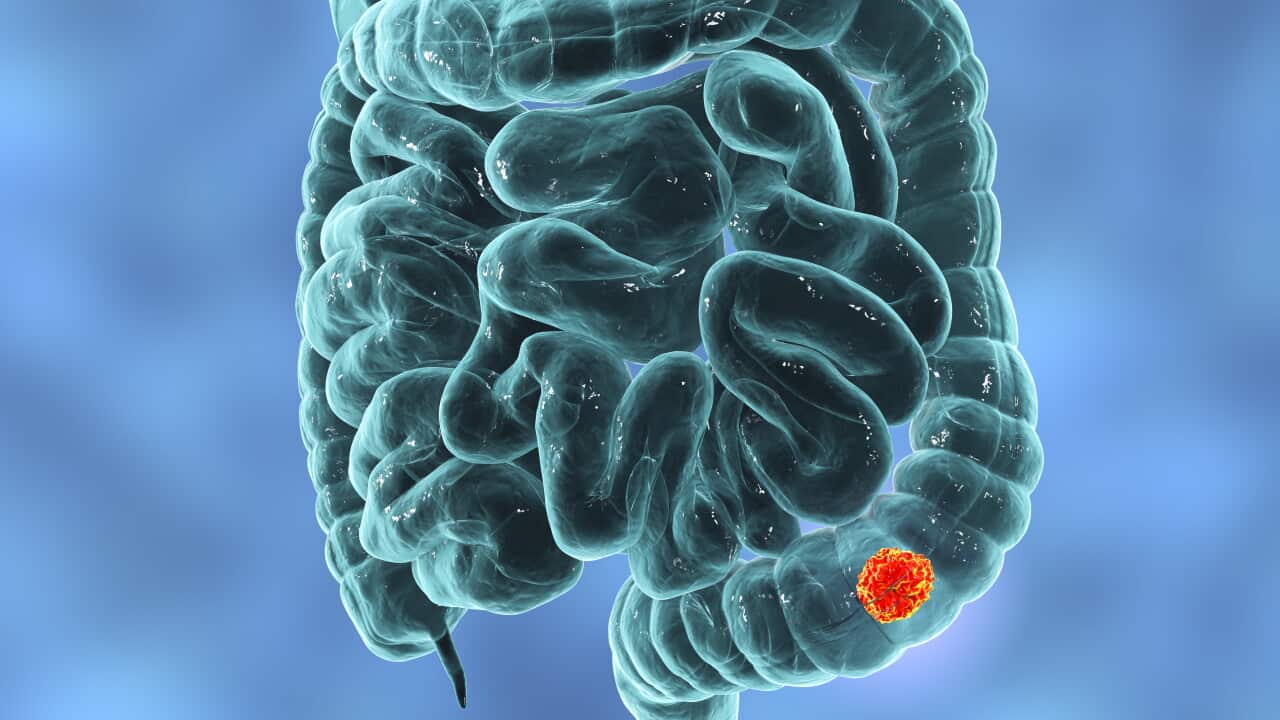 Colon cancer, illustration
