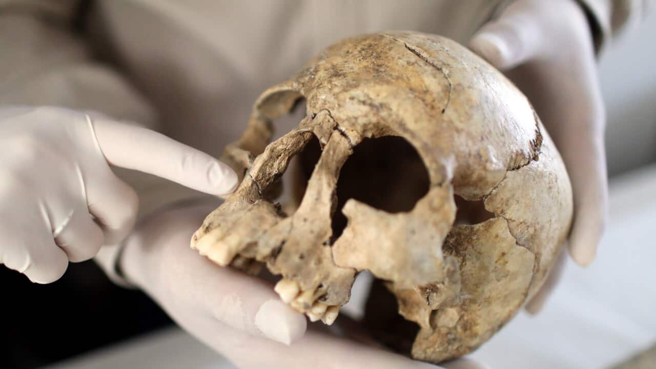 Gloved hands hold a weathered human skull while one finger points to the eye socket, showing cracks, missing teeth and signs of age or damage.
