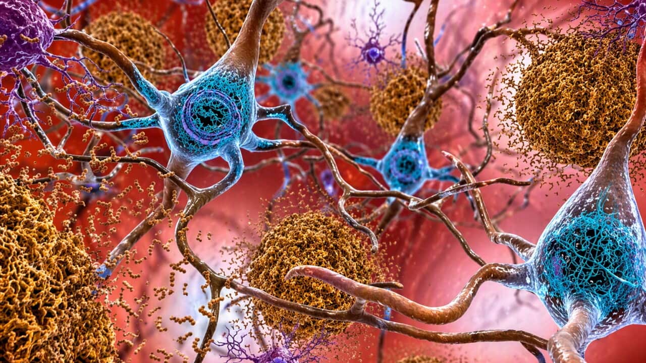 Illustration showing how tau and amyloid-β linked to dementia, form tangled sticky plaques in the brain (AP).jpg