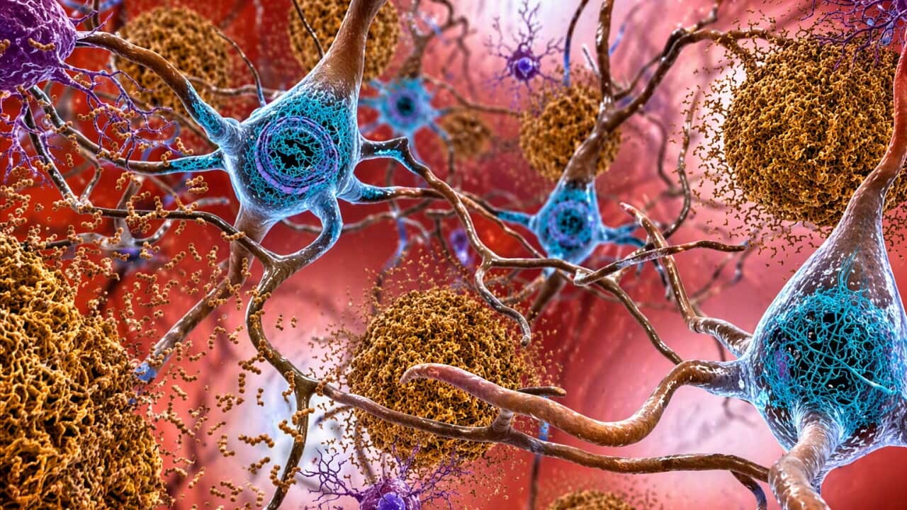 Illustration showing how tau and amyloid-β linked to dementia, form tangled sticky plaques in the brain (AP).jpg