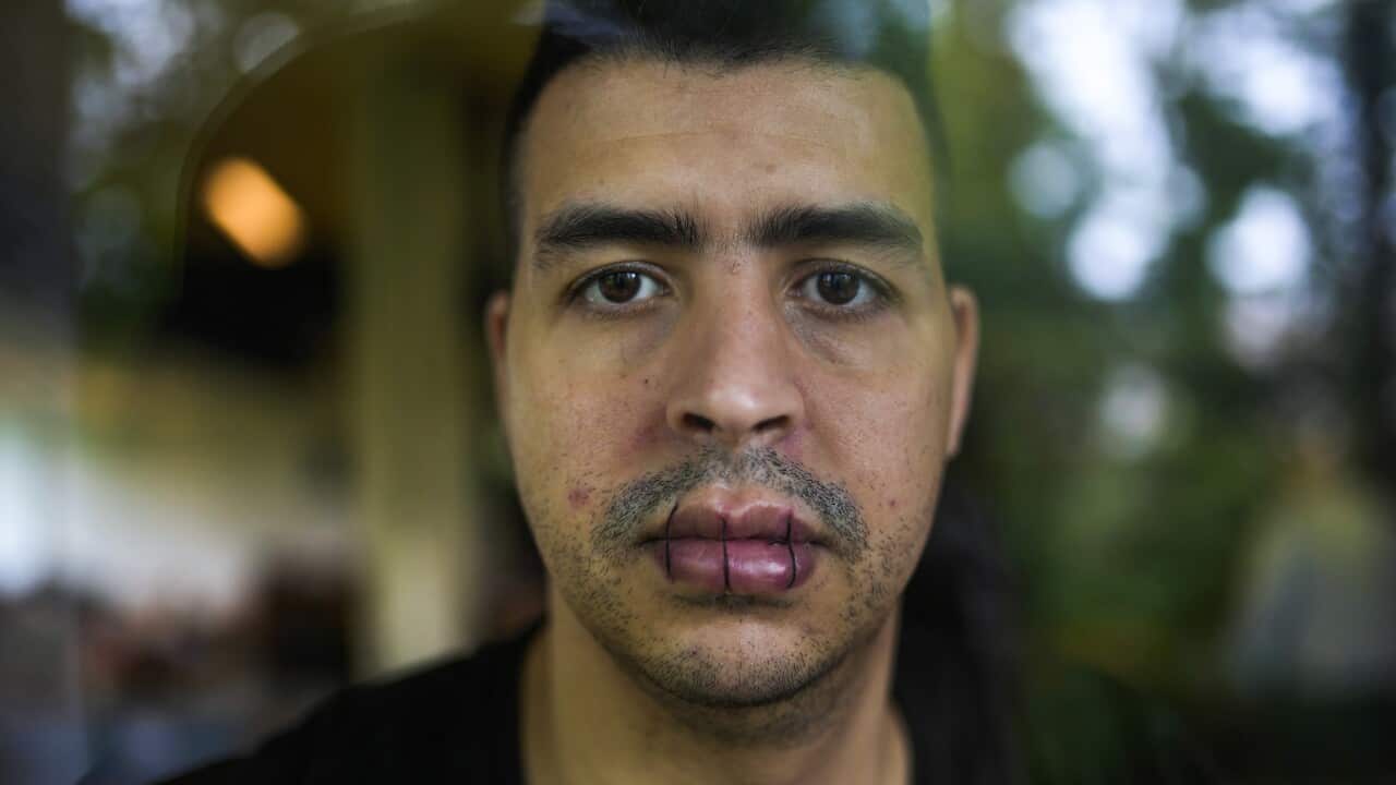A man from Morocco, no name given, with his lips sewn together and on hunger strike in Brussels