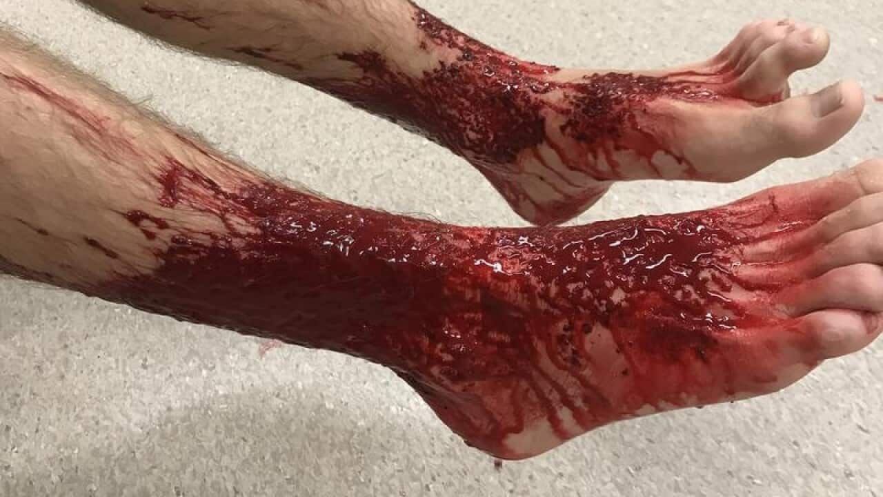 Sam Kanizay bloodied feet.