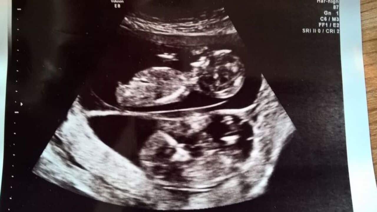 The Queensland twins are the first pair of semi-identical twins in the world to be identified during pregnancy.