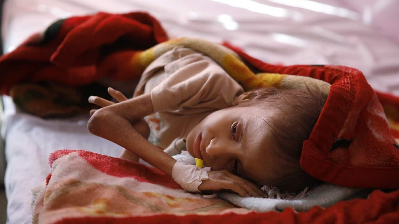 A malnourished child lies in a bed waiting to receive treatment at a therapeutic feeding center in a hospital in Sanaa, Yemen.