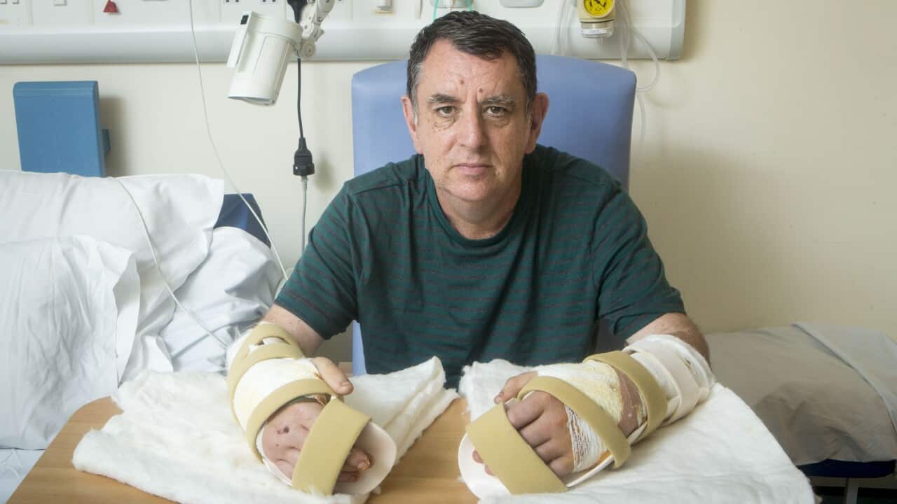 The UK's first double hand transplant patient Chris King, from Doncaster, with his new hands at Leeds General Infirmary.. Picture date: Thursday July 21, 2016. See PA story HEALTH Hands. Photo credit should read: Danny Lawson/PA Wire