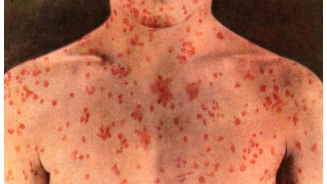 Measles outbreak in Melbourne