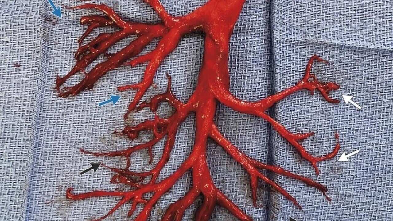 Human Blood Clot
