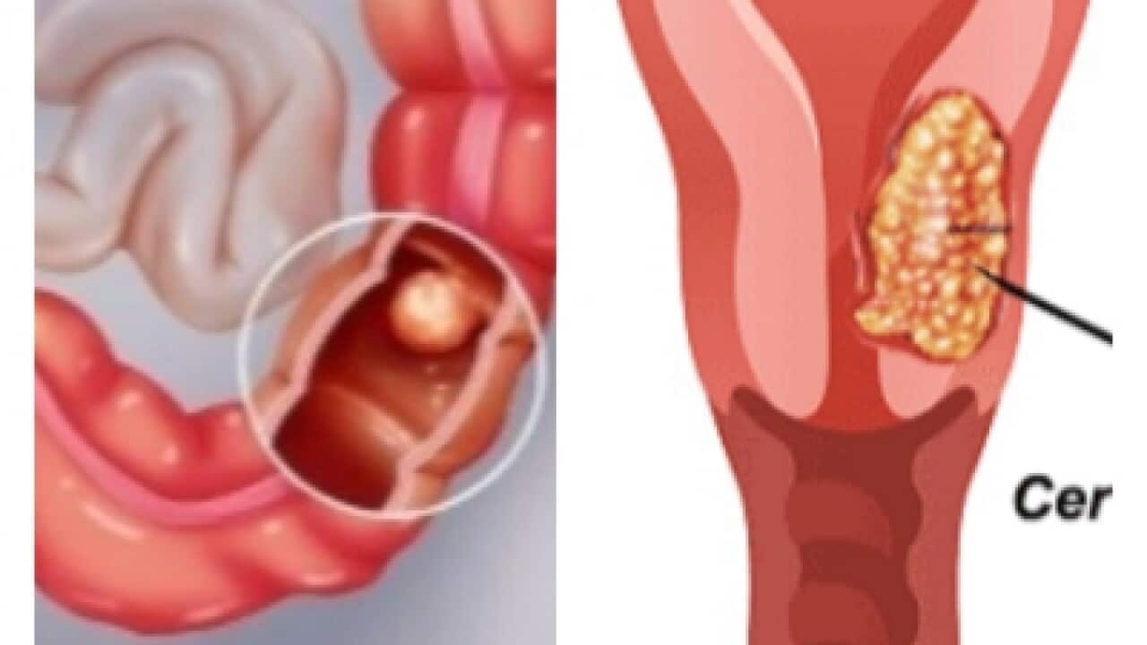 Bowel and Cervical Cancers