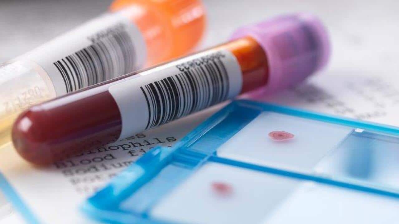 HIV AIDS test – Getty Images