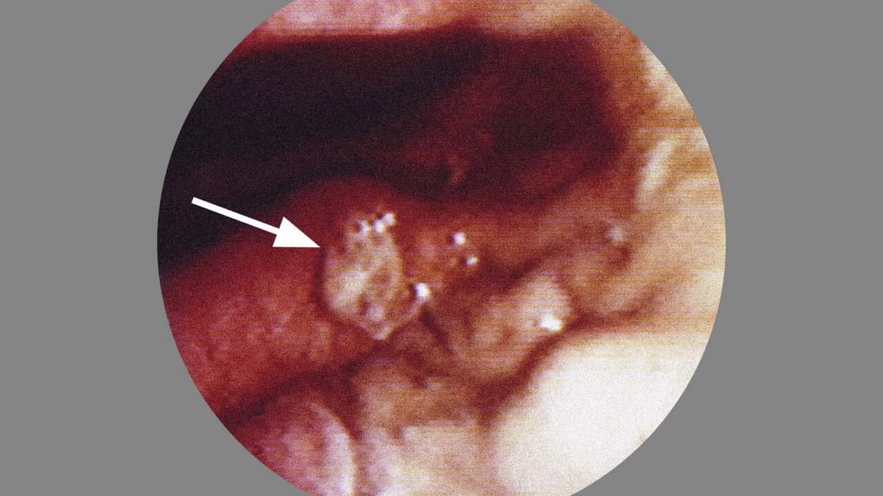 Gastric Ulcer, Endoscopy