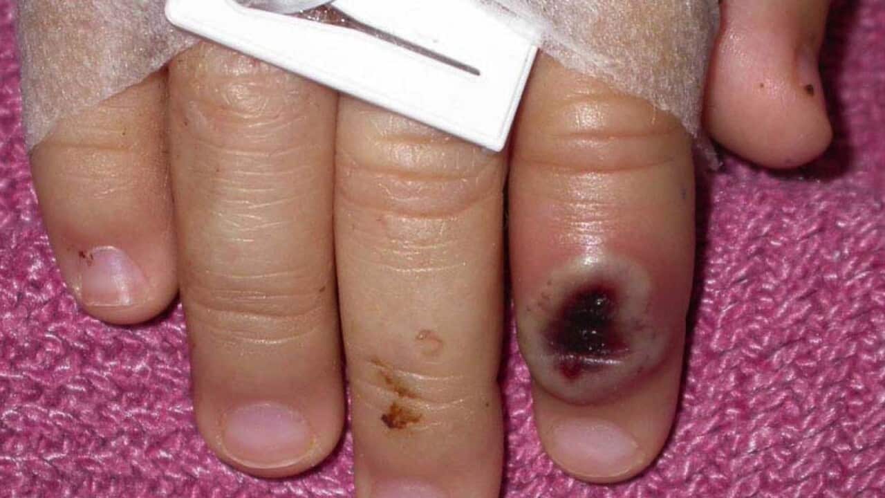 Skin lesions caused by the monkeypox