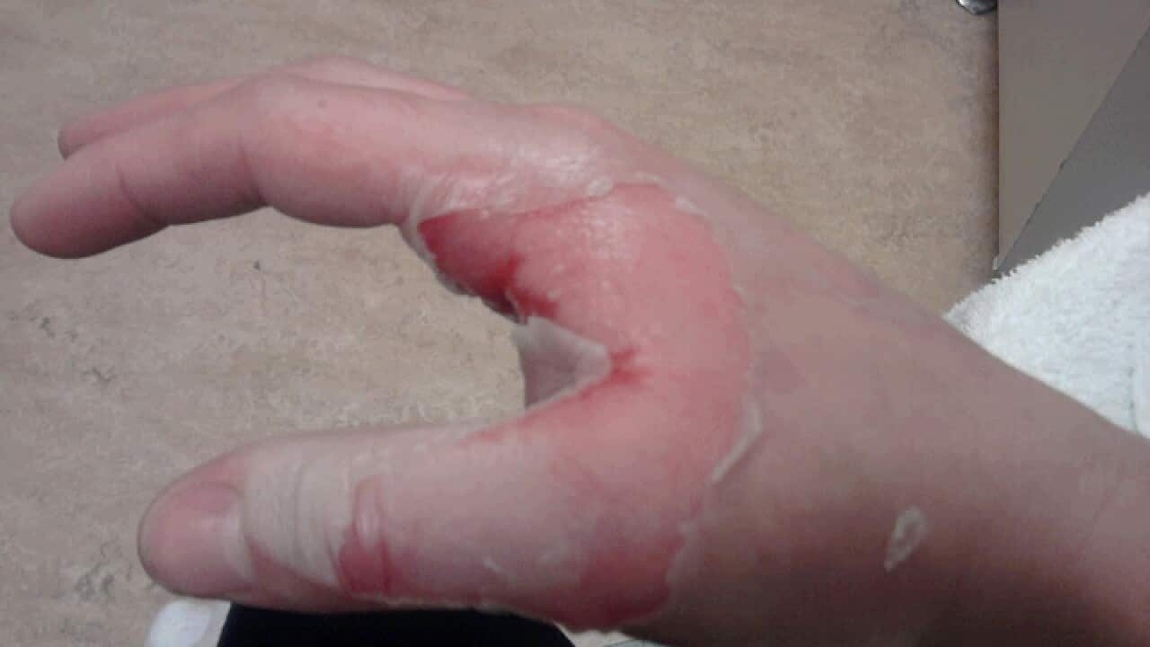 Burns awarness month in Australia