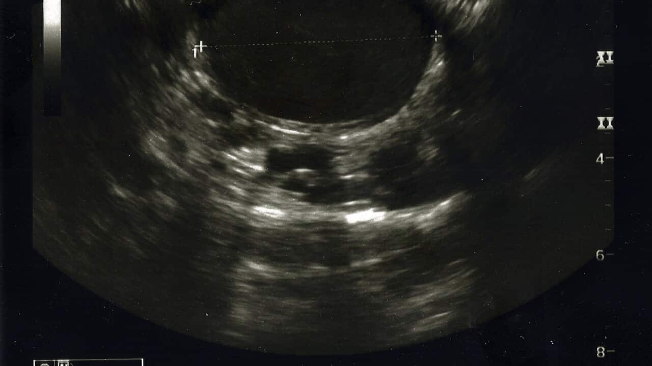 An endometriosis cyst ultrasound scan