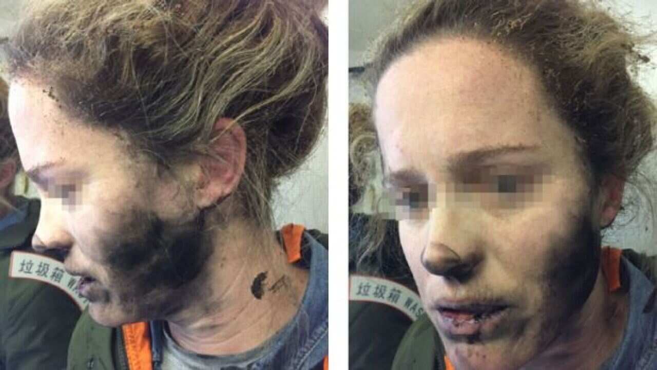 The injuries sustained from the exploding headphones