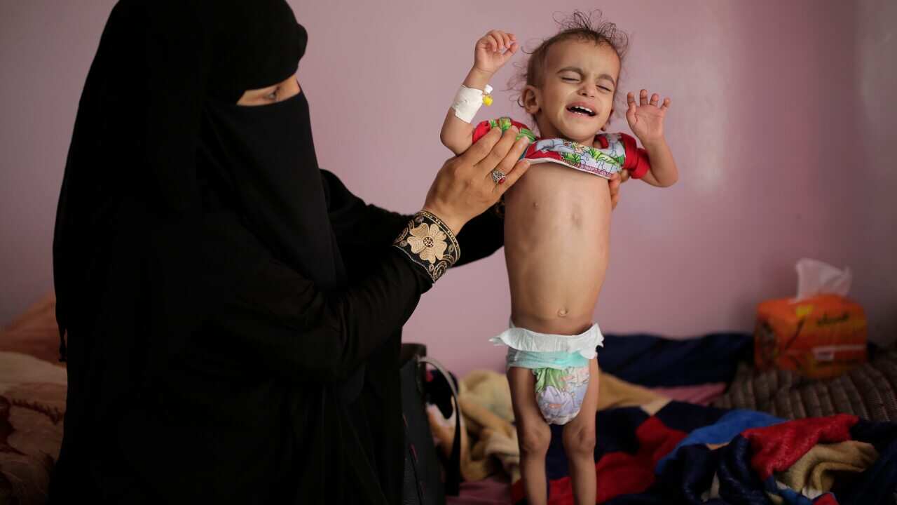 A woman holds her malnourished boy at a feeding center at the Al-Sabeen Hospital in Sanaa, Yemen.