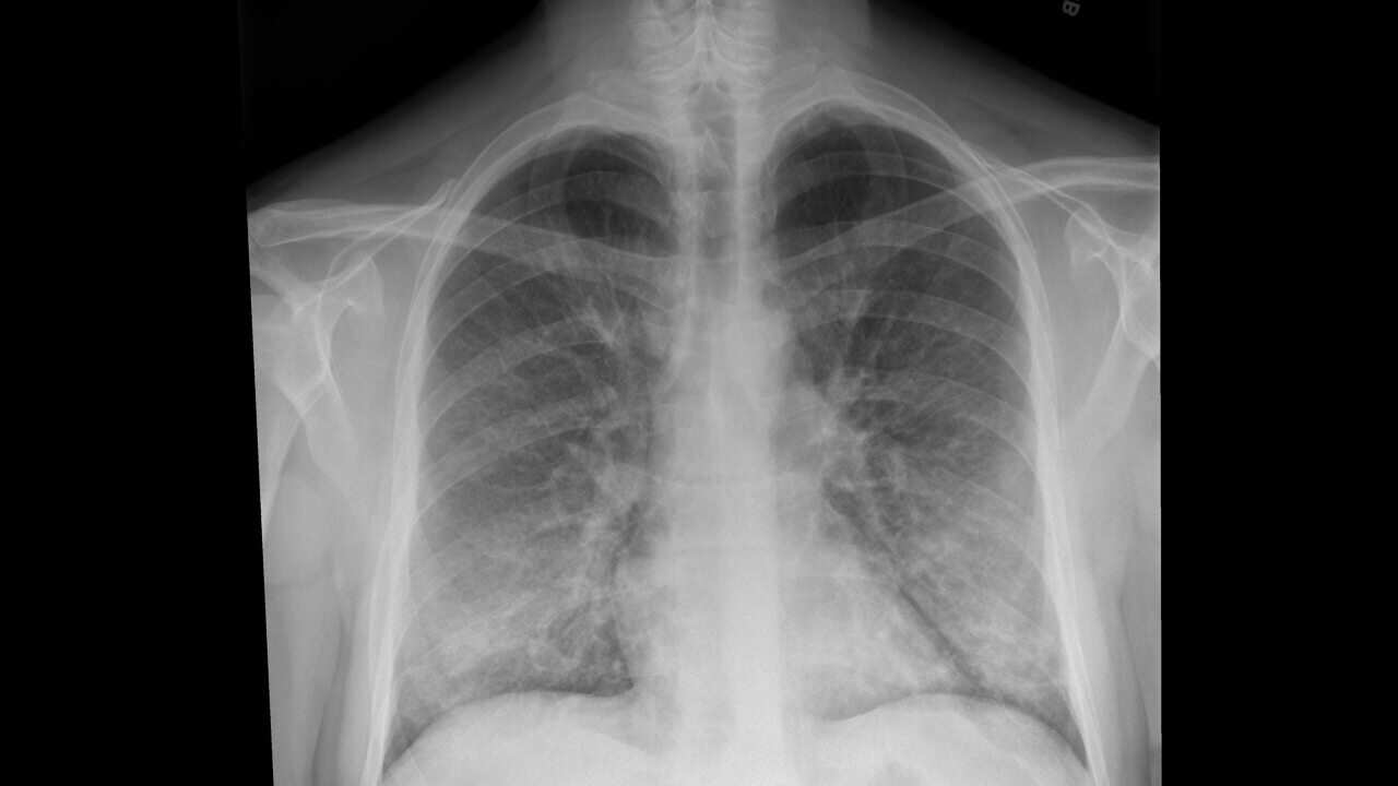 An X-ray of a patient with a vaping habit, showing lung damage.
