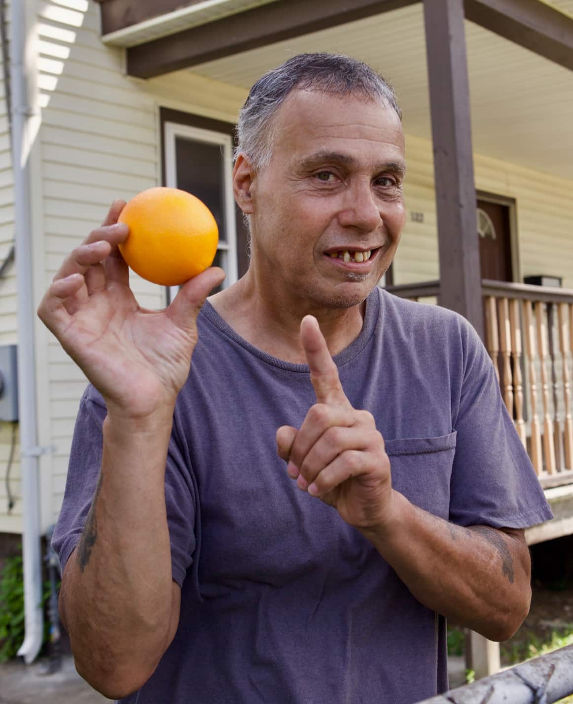 Sonny Lopez, a 60-year-old resident of Springfield in the  USA, was diagnosed with scurvy resulting from a severe lack of dietary vitamin C.