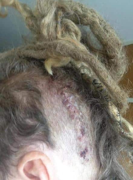 Frenzal Rhomb tapeworm