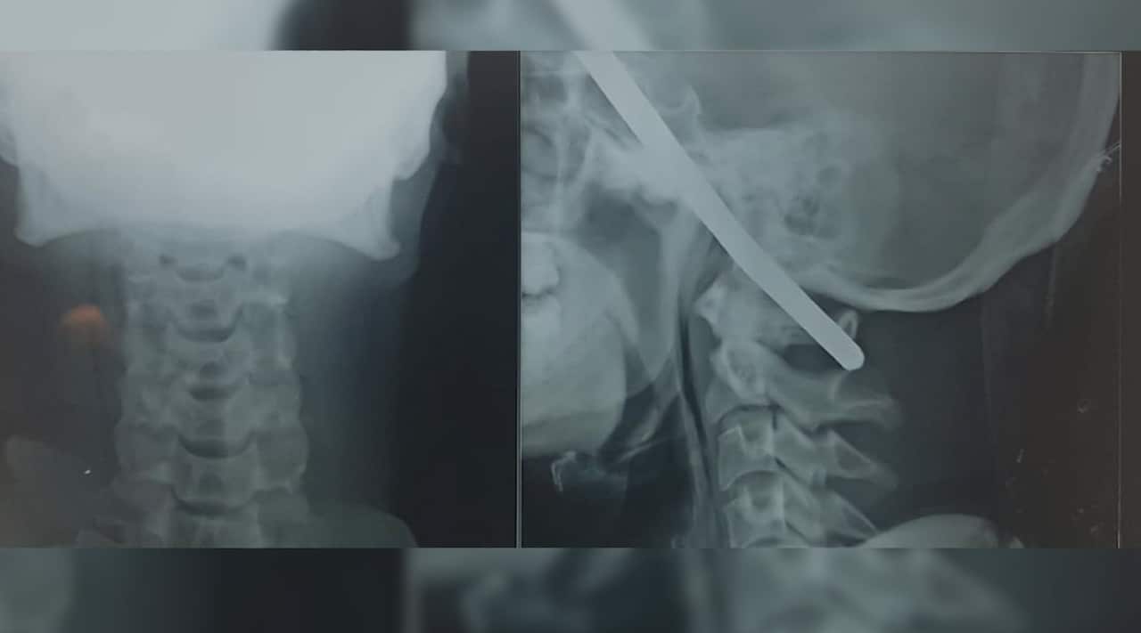 The rod was removed safely with hardly any bleeding or injury to the surrounding area.