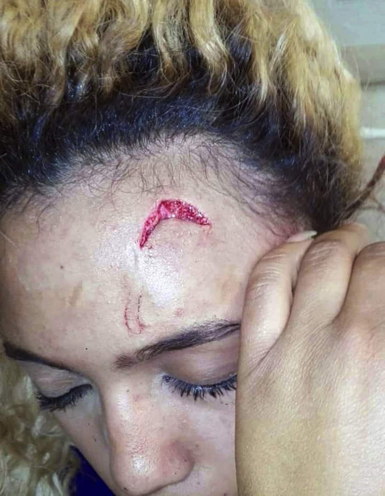  In this photo provided by Debbie Engels and taken on Monday, Aug. 14, 2017, Gabriella Engels is seen with an injury to her forehead in Johannesburg