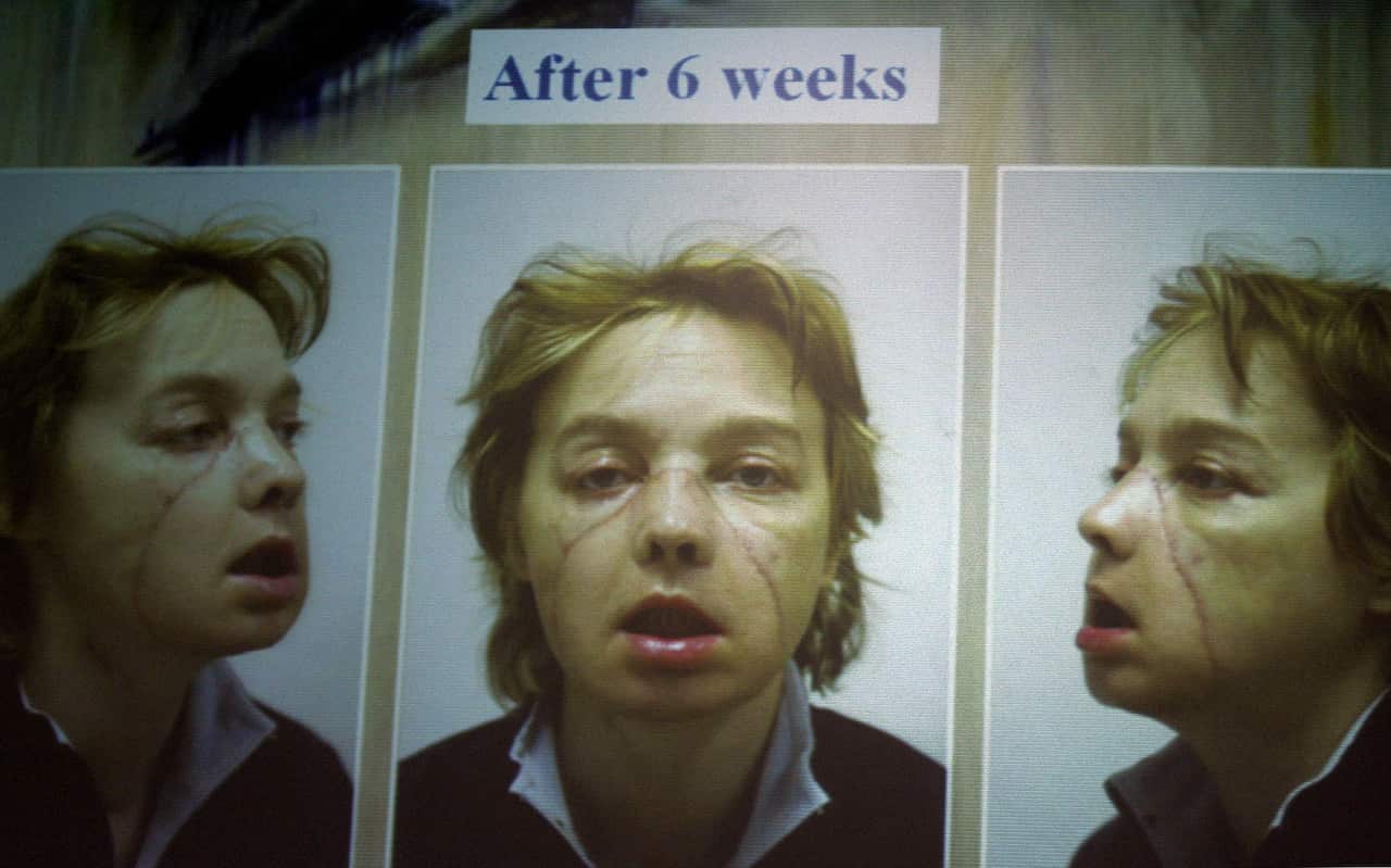Isabelle Dinoirereceived the world's first partial face transplant with part of a nose, chin and lips 