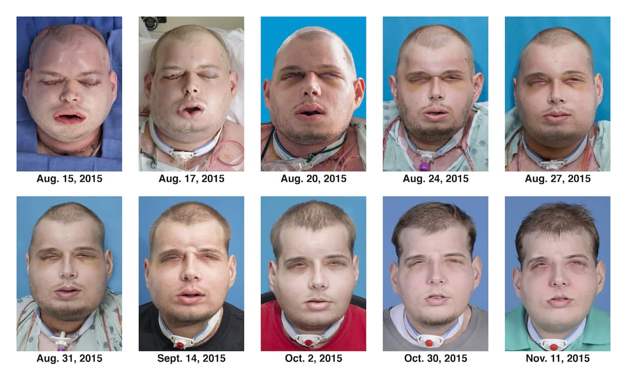 The recuperation of Patrick Hardison after his facial transplant surgery in New York. NYU Langone Medical Center via AP)