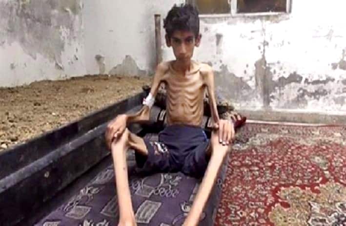 This undated photo posted on the Local Revolutionary Council in Madaya, which has been verified and is consistent with other AP reporting, shows a starving boy in Madaya, Syria. 