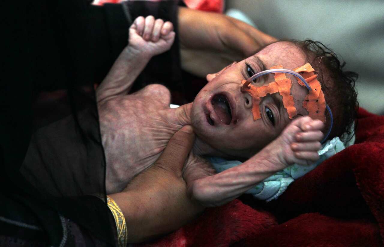 According to UN recent reports, more than three million Yemeni children under the age of five are at risk of severe acute malnutrition.