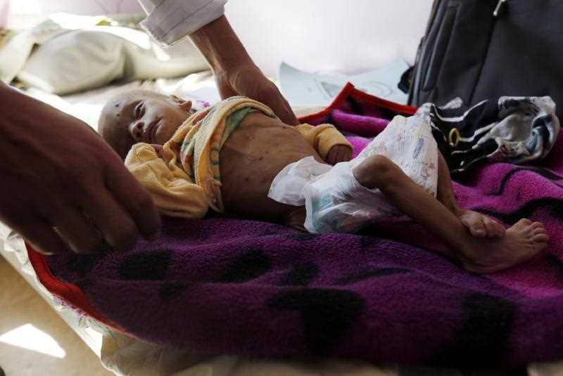  A malnourished Yemeni child receives treatment amid worsening malnutrition at a hospital in Sana'a, Yemen, 24 November 2017.