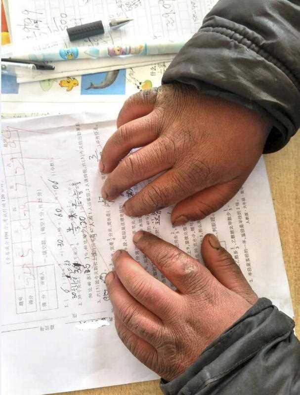 The primary student with frozen hair shows his hands as he takes classes in a primary school in Zhaotong city, southwest China's Yunnan province, 8 January 2018. A primary student braved cold to go to school in Zhaotong city, southwest China.