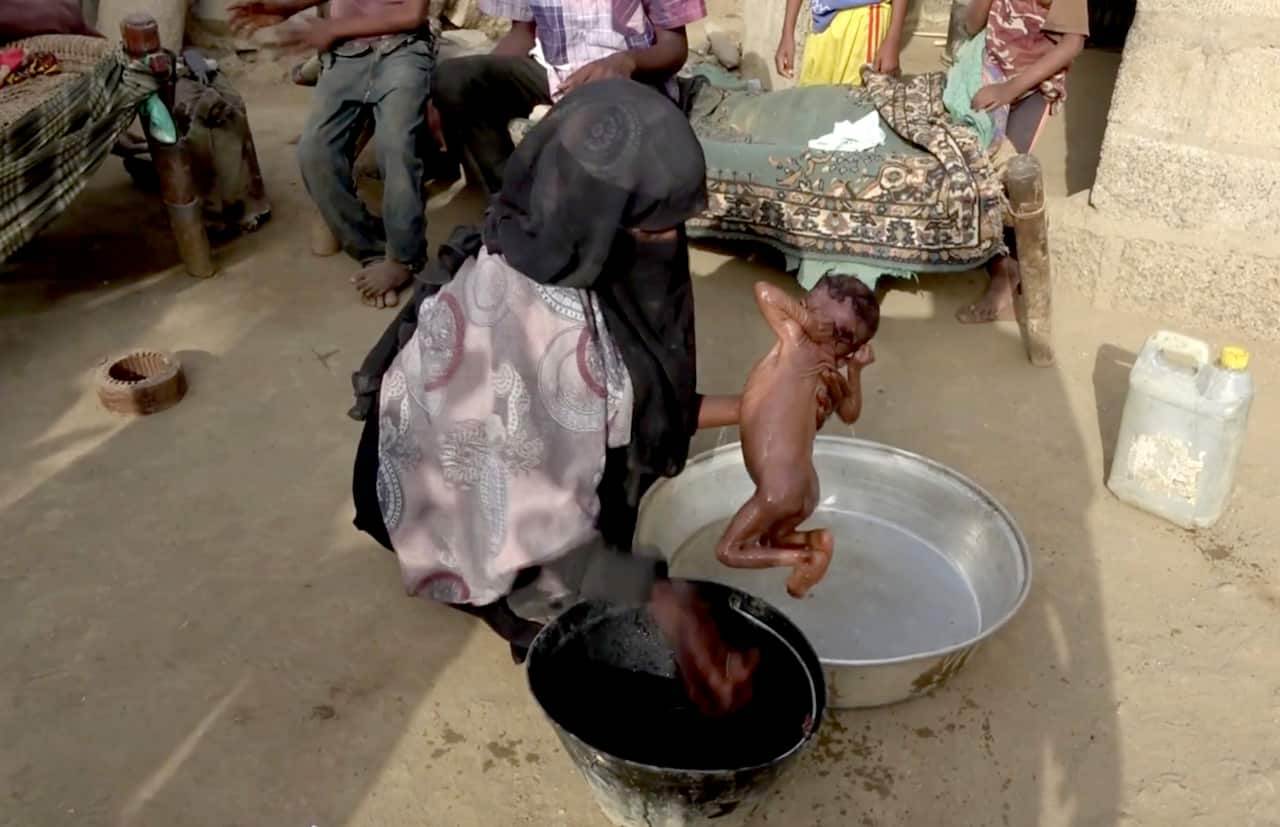 Severely malnourished infant Zahra is bathed by her mother, in Aslam, Hajjah, Yemen.