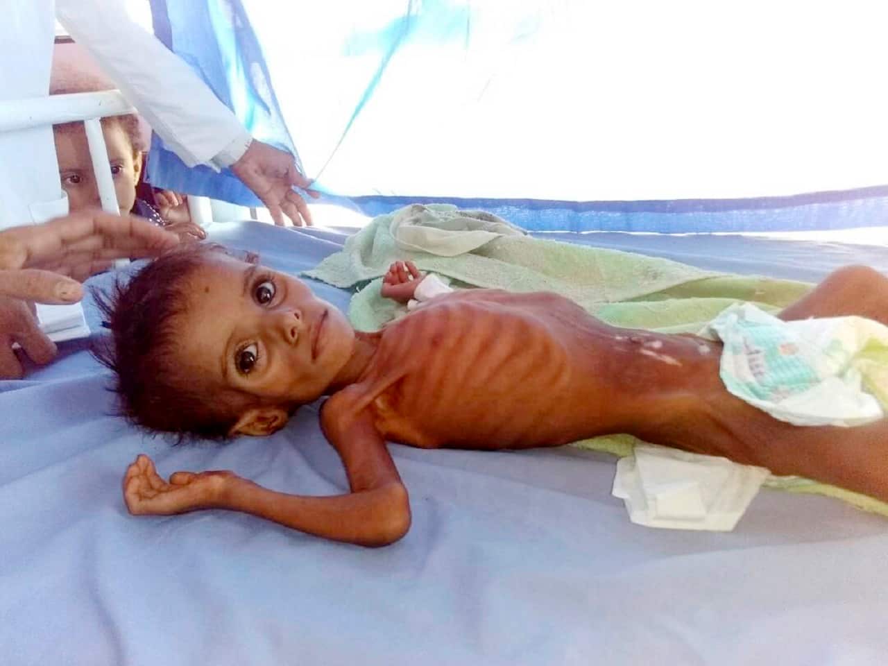 A severely malnourished child at the Aslam Health Center in Hajjah, Yemen.