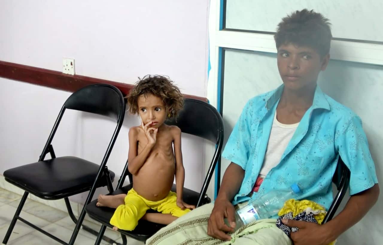 A severely malnourished girl waits for her turn to be treated at the Aslam Health Center in Hajjah, Yemen.
