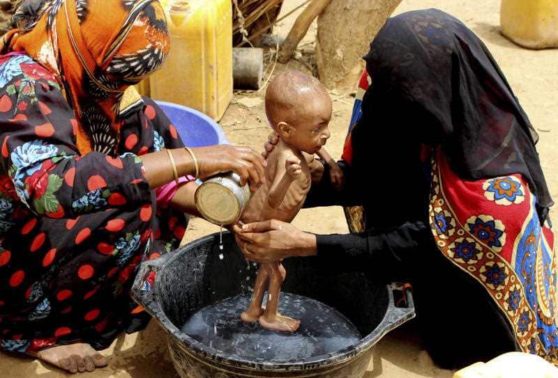 A severely malnourished infant is bathed in a bucket in Aslam, Hajjah, Yemen