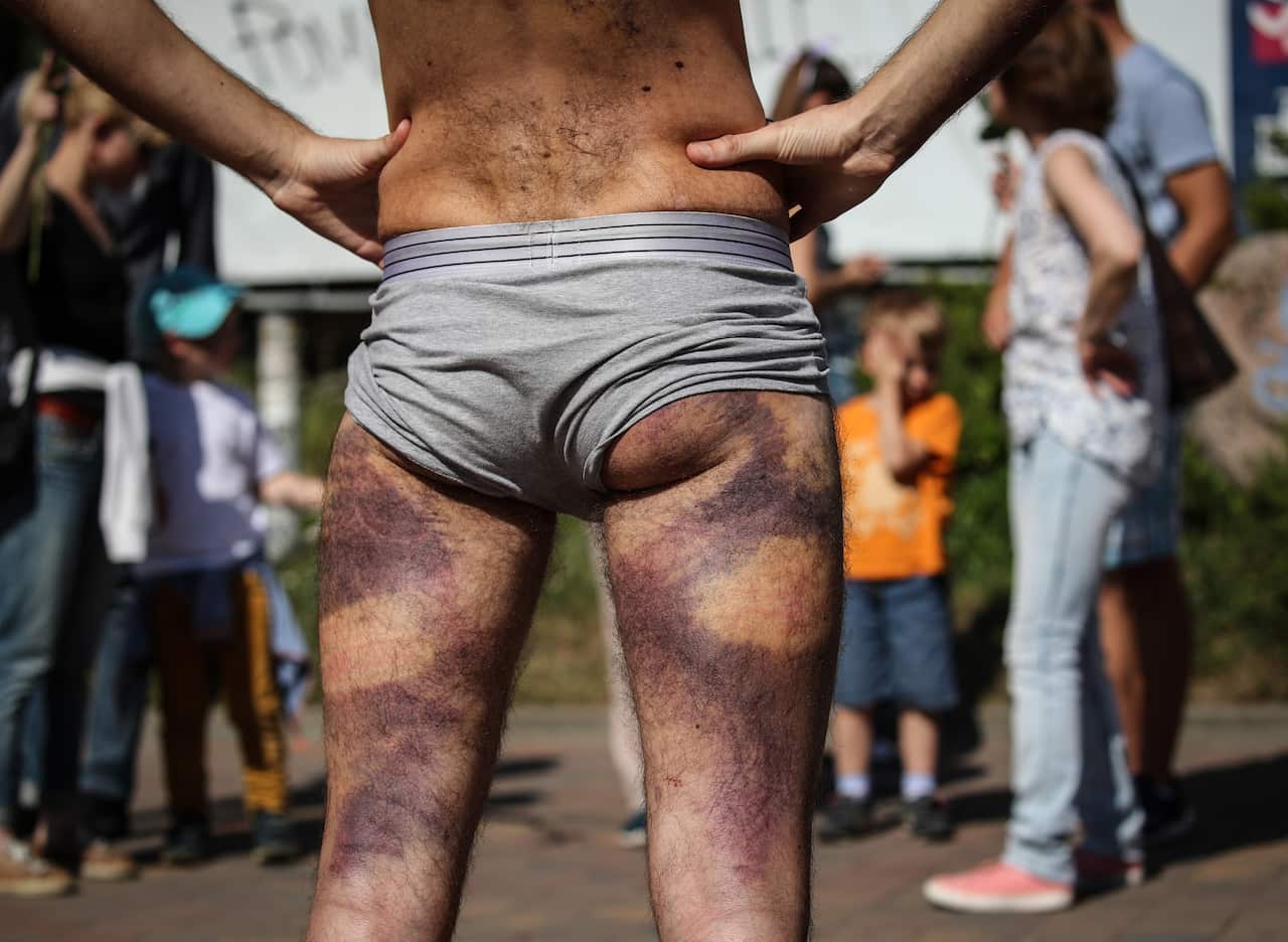Artem Pronin shows his bruises, which he reportedly got after her was beaten by the police in a detention centre, during a rally in Minsk on 15 August.