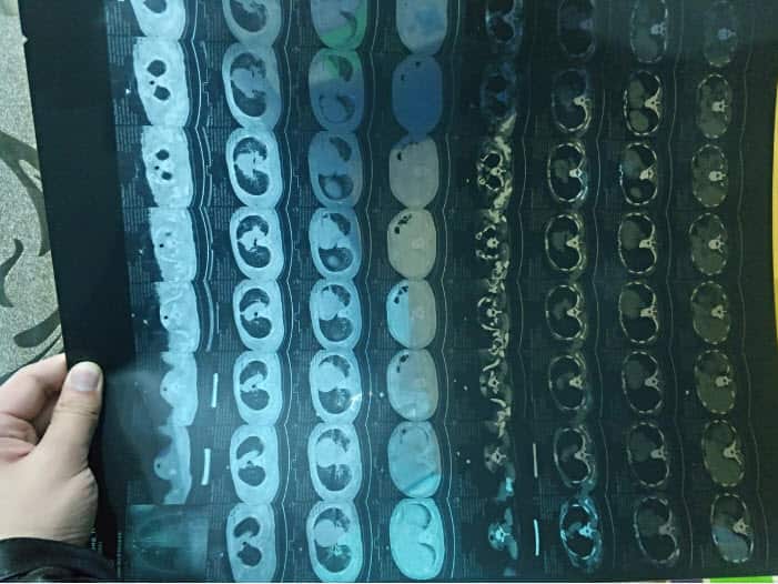 Zhang Changchun shows a CT scan image of the lungs of his mother, Yang Zhongyi, who is a highly suspected case of the new coronavirus