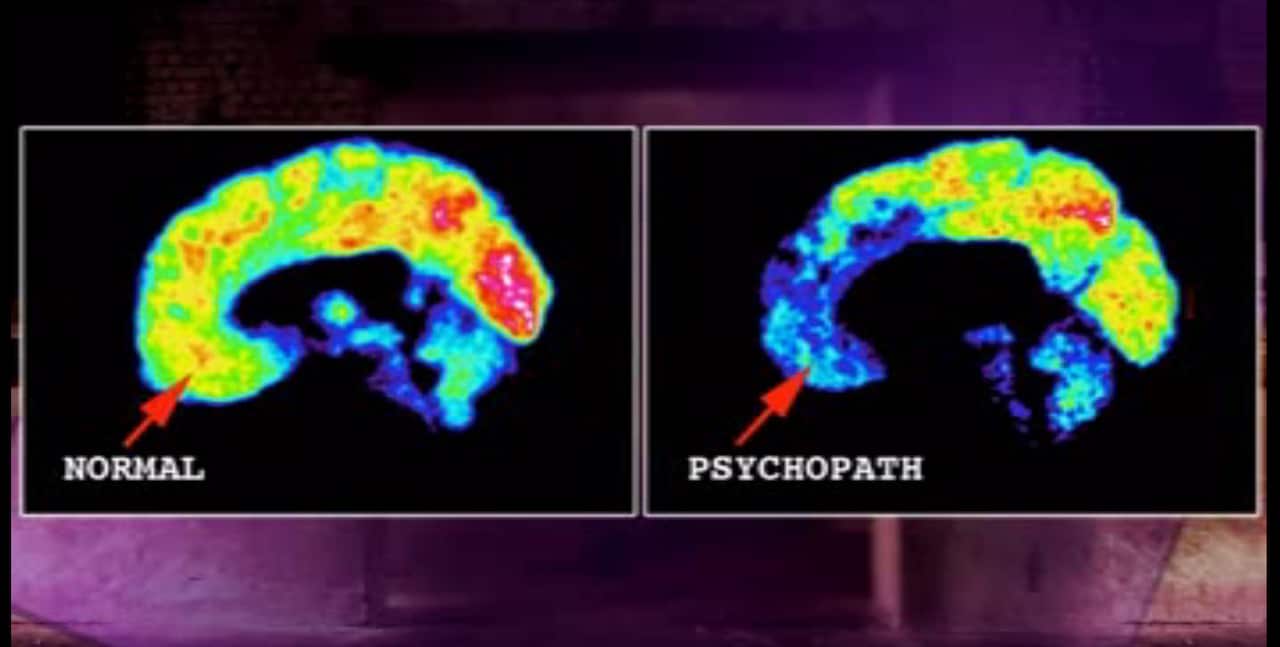 Jim says his orbitofrontal cortex is abnormal.