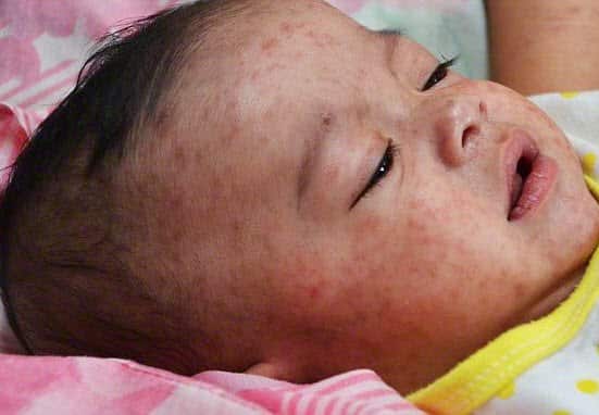 Three NSW measles cases in under a week