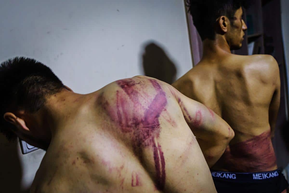 Afghan journalists Nemat Naqdi and Taqi Daryabi with injuries to their backs.