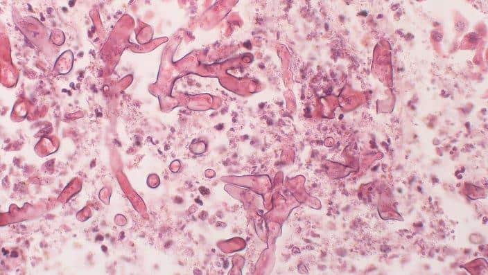 Zygomycosis/ mucormycosis under microscope.