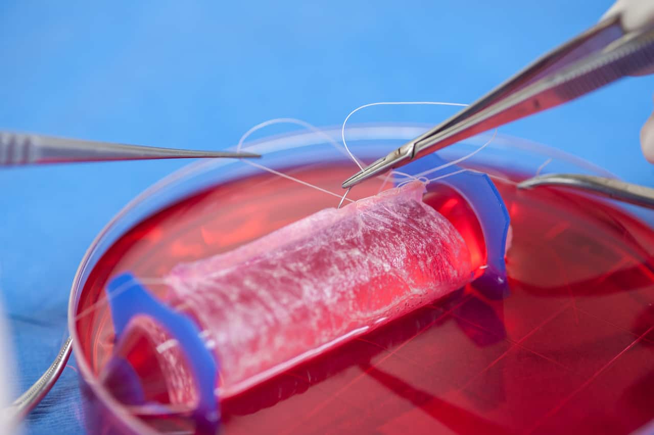 Cells are placed onto biodegradable “scaffolds” which are hand-sewn into a vagina-like shape.  (Photo: Wake Forest Institute for Regenerative Medicine)