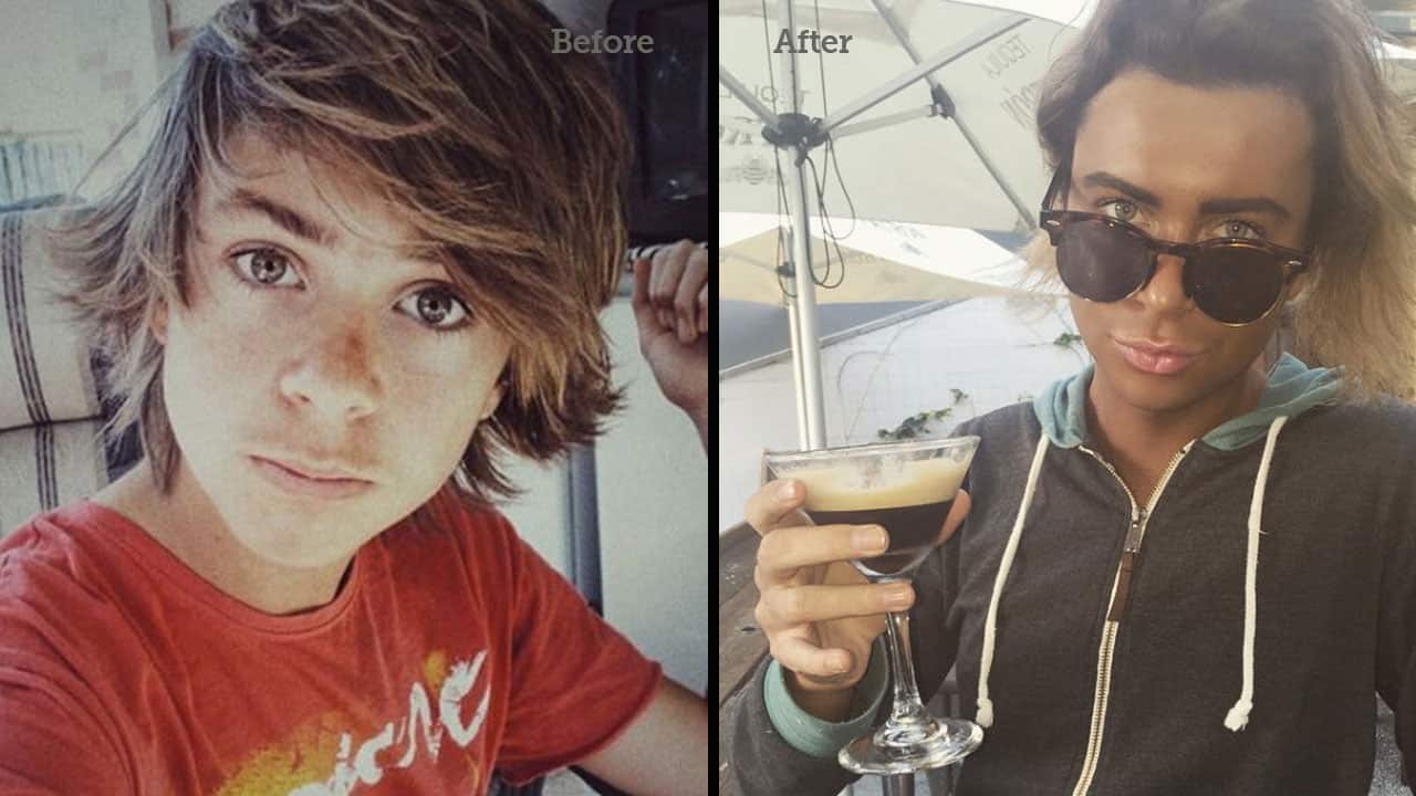 Insight guest Kurt Coleman, before cosmetic procedures (left) and after (right)