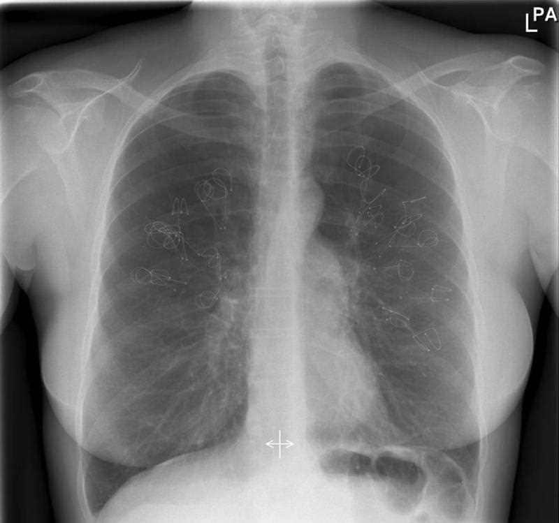 The report found one in five people diagnosed with lung cancer didn't receive any form of treatment.