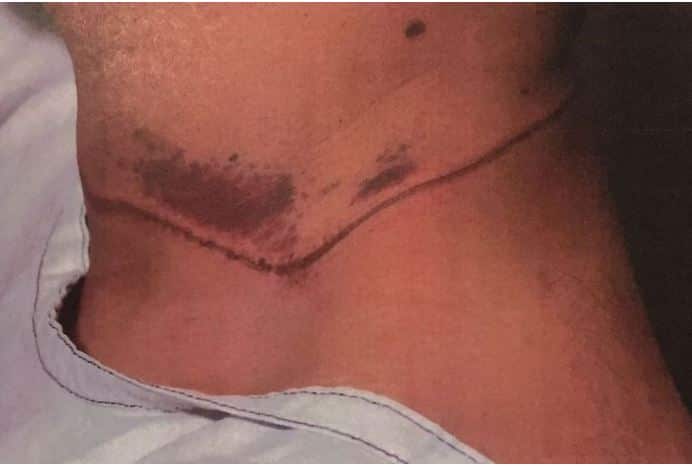 The injury on Abdolhadi Moradi's neck.